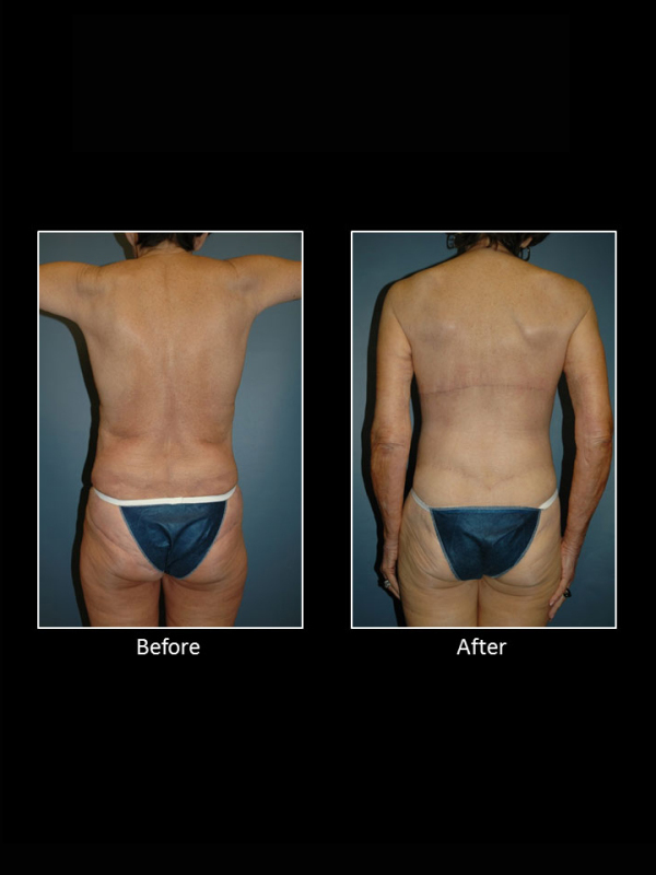 Back Lift (Bra Line Back Lift) Before and After Photo Gallery