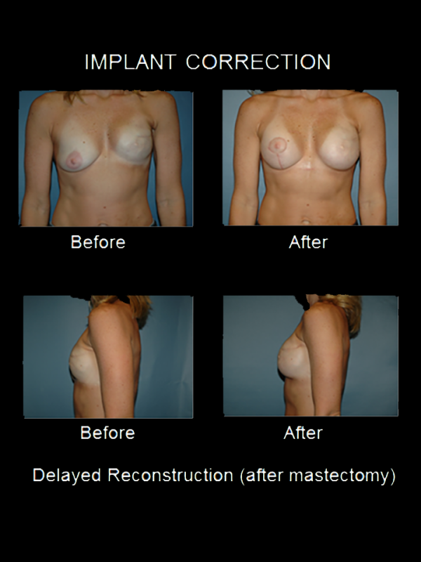 Post-Mastectomy Consultations
